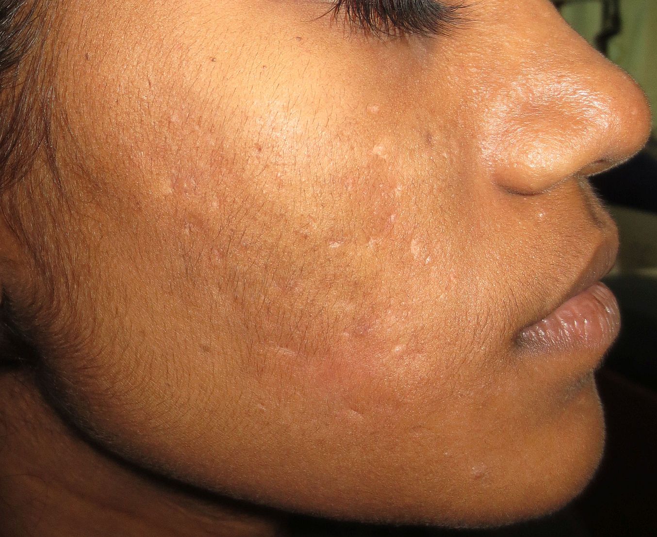 Before acne scar treatment