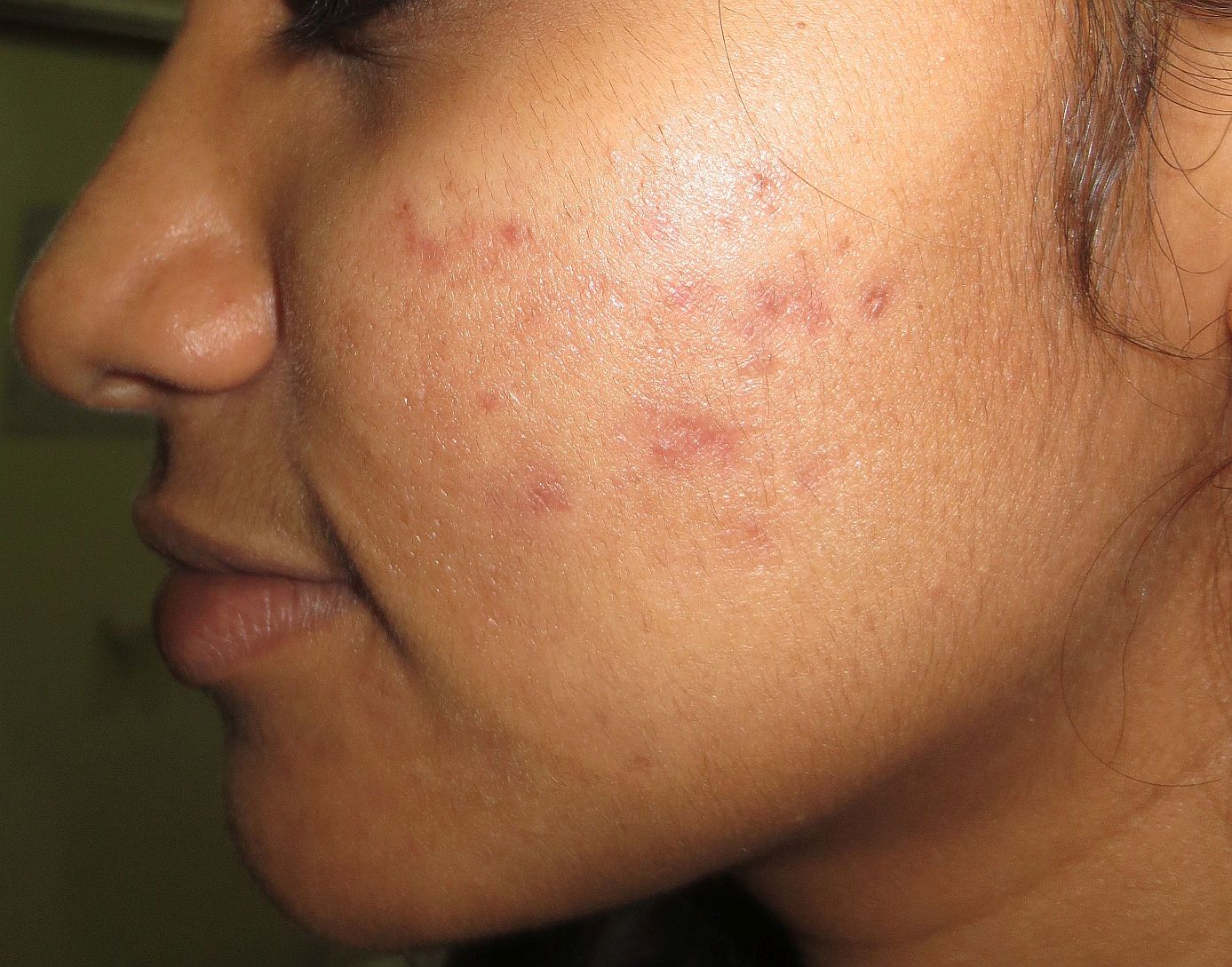 Before acne scar treatment
