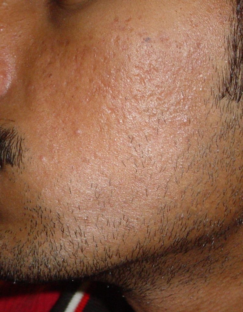 Before acne scar treatment