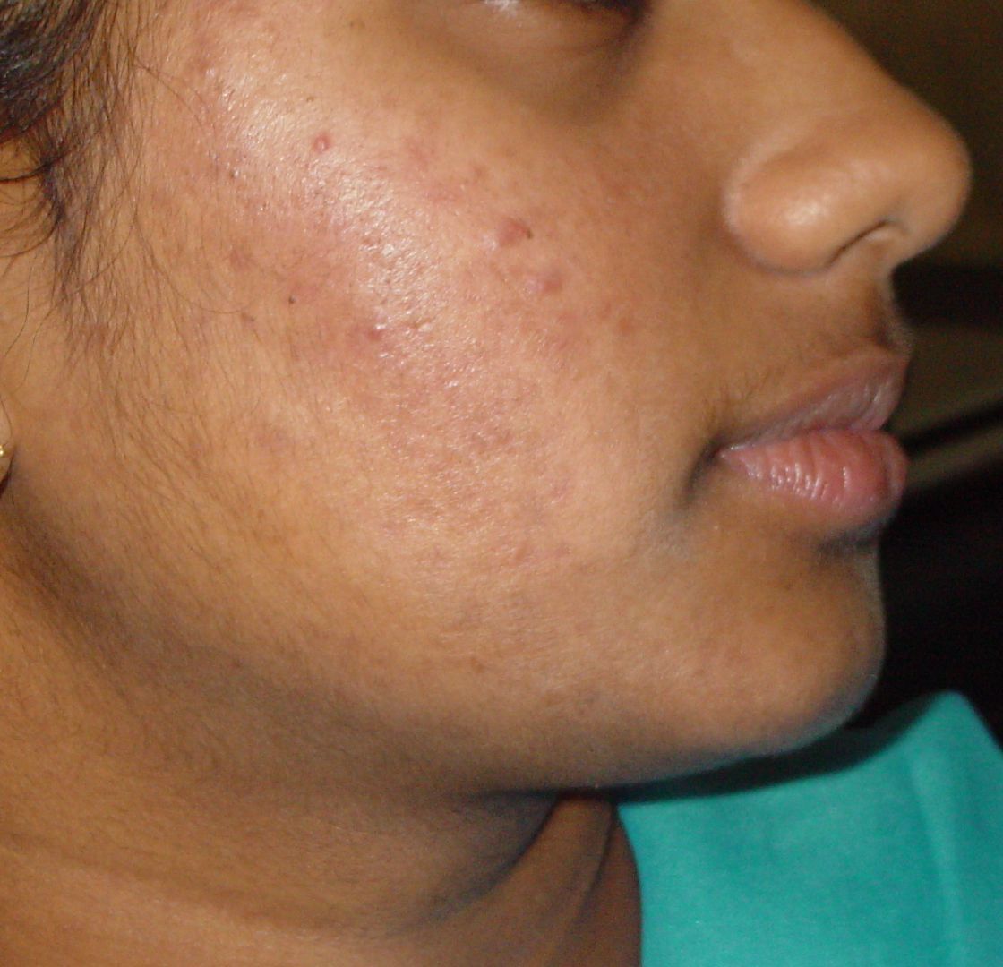 Before acne treatment
